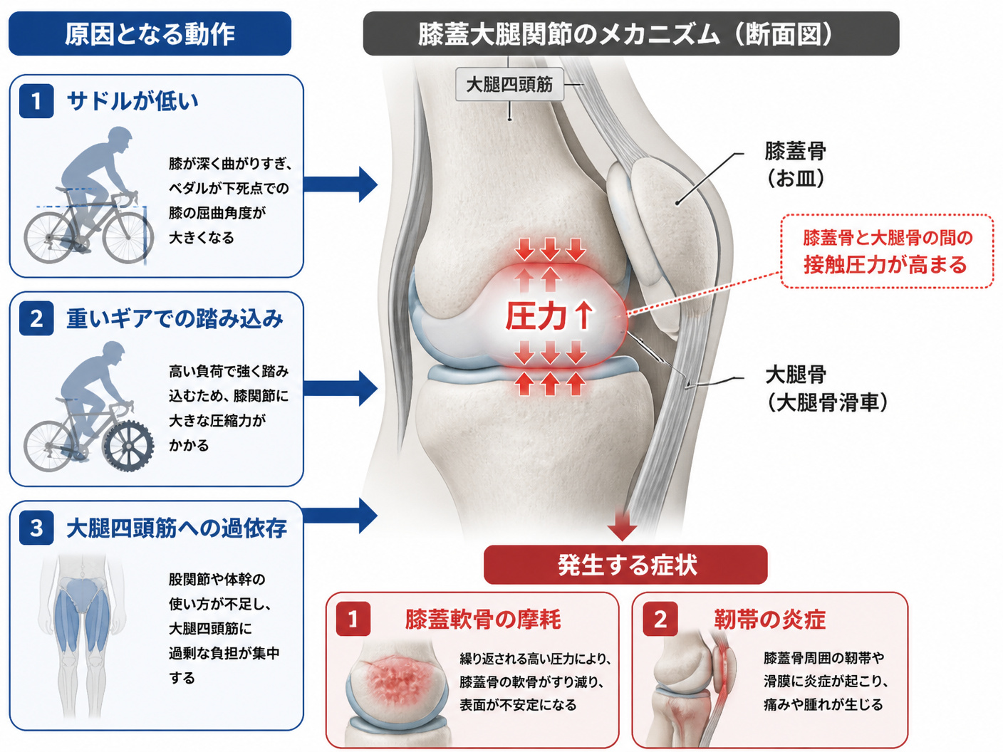 【文脈】膝の前面（お皿周り）の痛みである膝蓋大腿関節症の発生メカニズムを視覚的に説明する図。読者は、サドルが低いことや重いギアがどのように膝への負担につながるかを理解したい。【図解指示】膝蓋大腿関節症のメカニズムを説明する構造図。中央に大きく膝関節の
